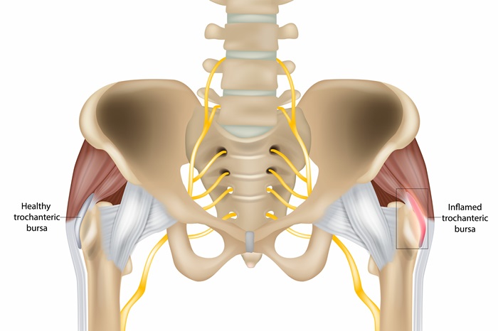 Hip Trochanteric bursitis is inflammation of the bursa. Healthy and inflamed trochanteric bursa. Greater trochanteric pain syndrome.