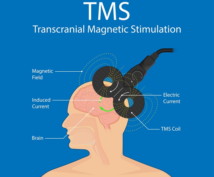 TMS Diagram