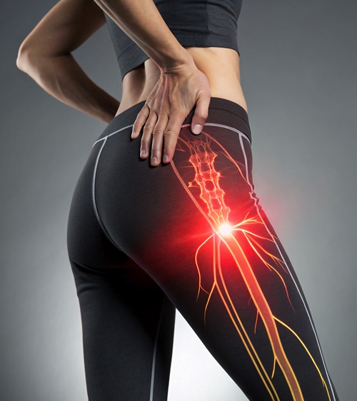 Low back pain radiating down the leg