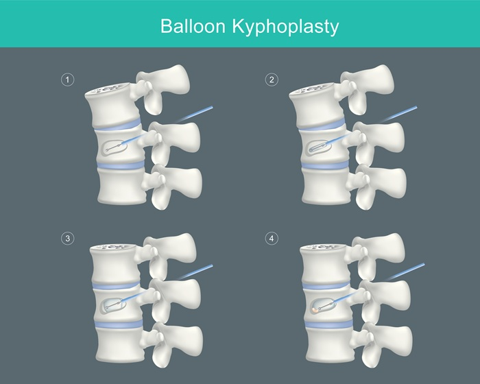 Balloon kyphoplasty