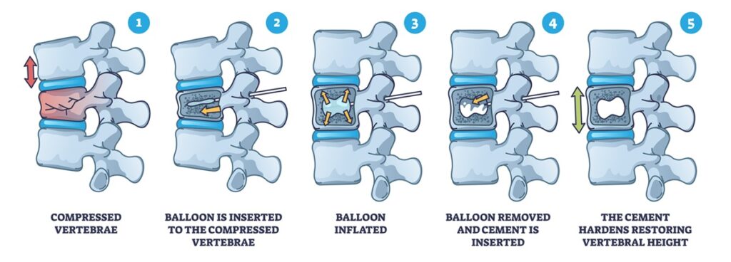 Kyphoplasty process