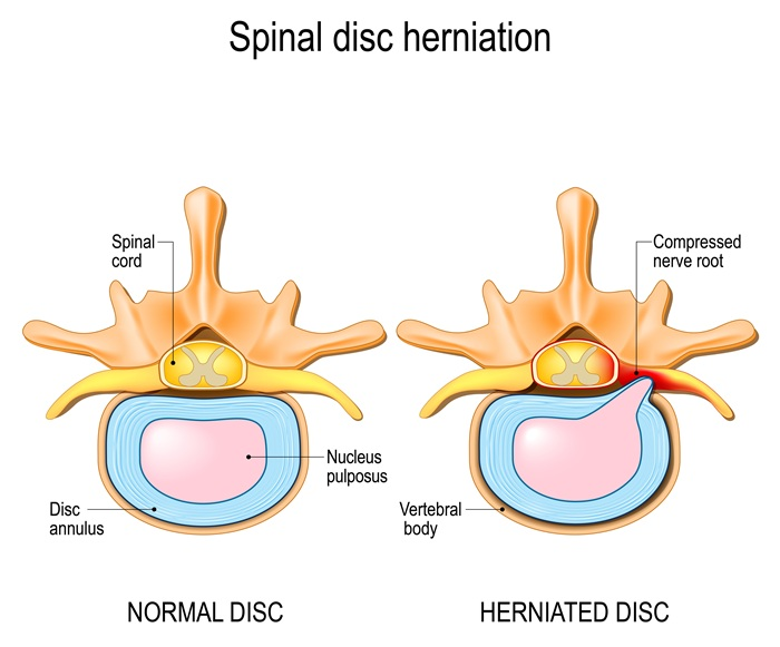 Diagram of a thoracic herniated disc