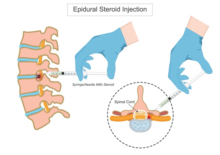 Epidural steroid injection graphic