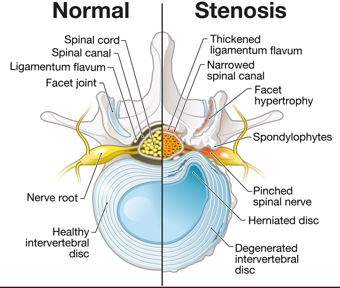 Diagram of a healthy spine verses spinal stenosis