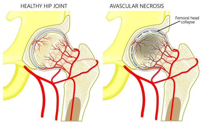 A healthy human hip joint and a hip with avascular necrosis of the femoral head. Front view.
