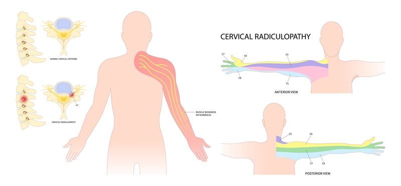 Cervical radiculopathy diagram