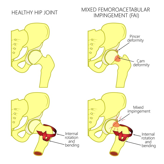 Hip impingement syndrome diagram