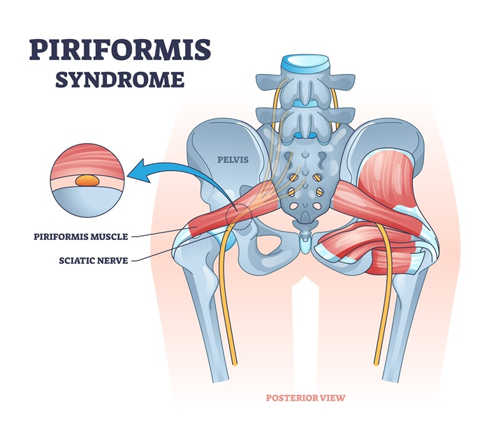 Piriformis syndrome diagram