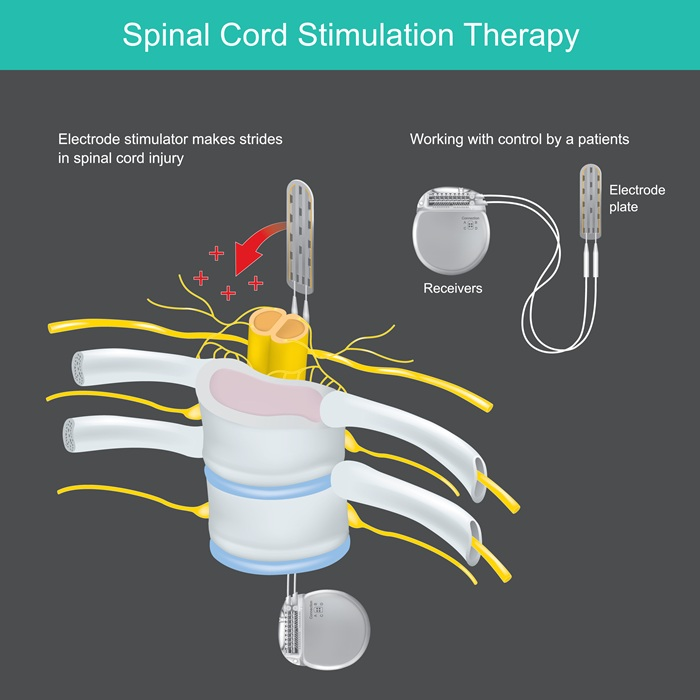 Diagram showing the components of a spinal cord stimulator