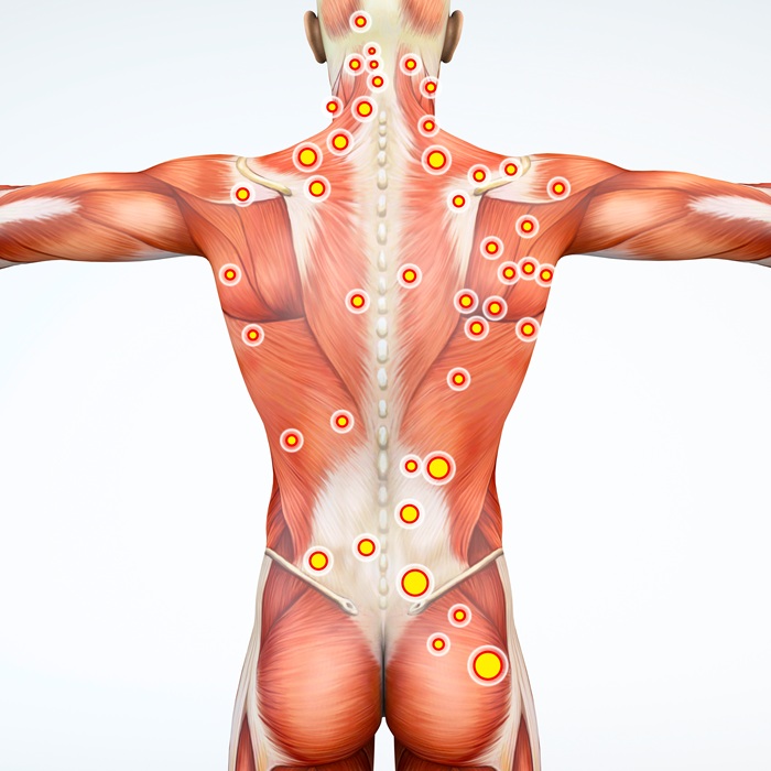 Diagram of trigger points