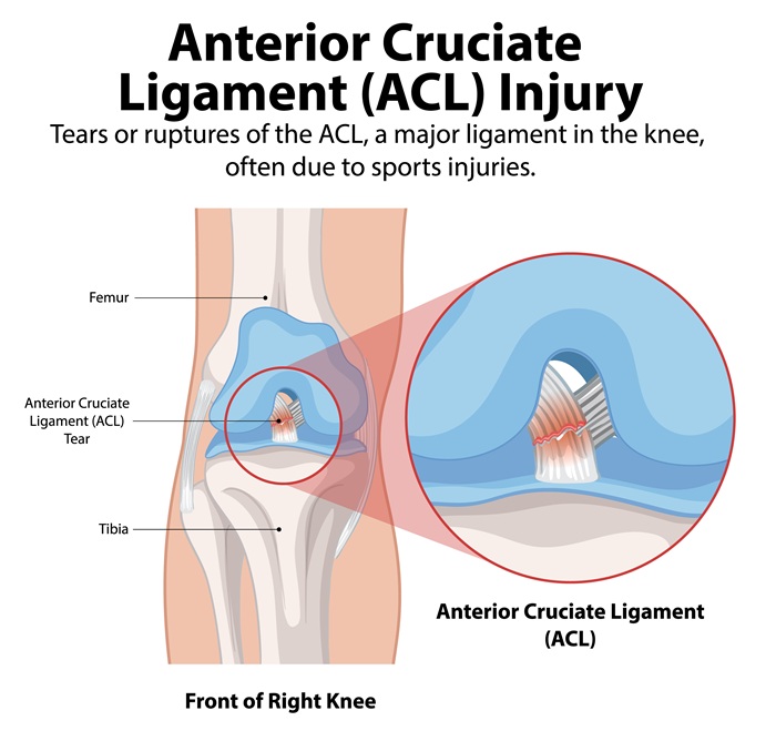 Anatomical diagram of an ACL injury