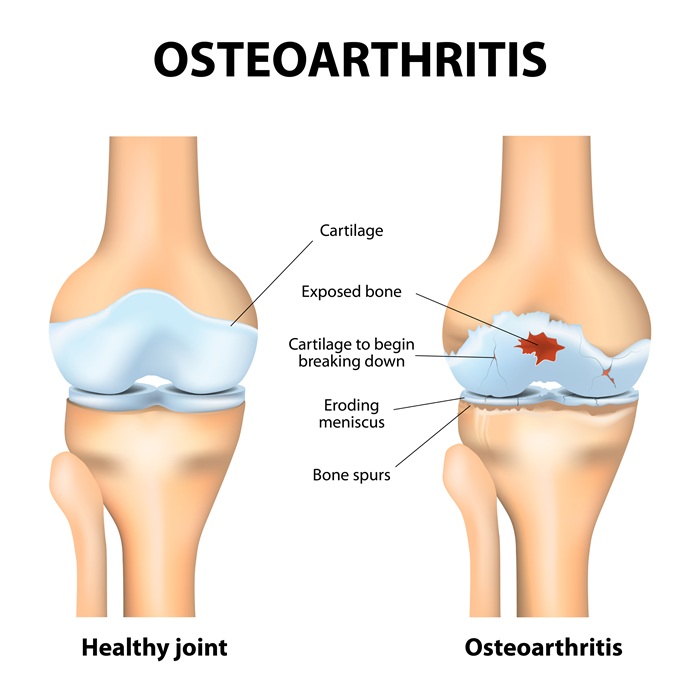 Diagram of osteoarthritis of the knee