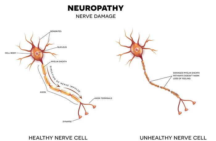 Diagram comparing a healthy nerve with an unhealthy nerve