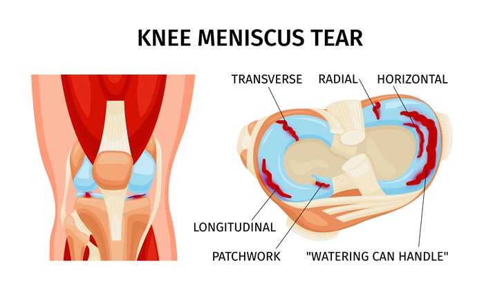 diagram of a meniscus tear