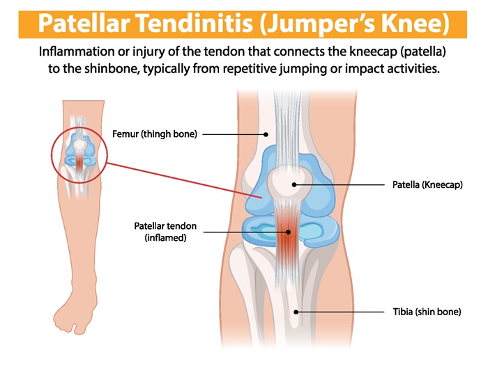 Patellar tendonitis diagnosis