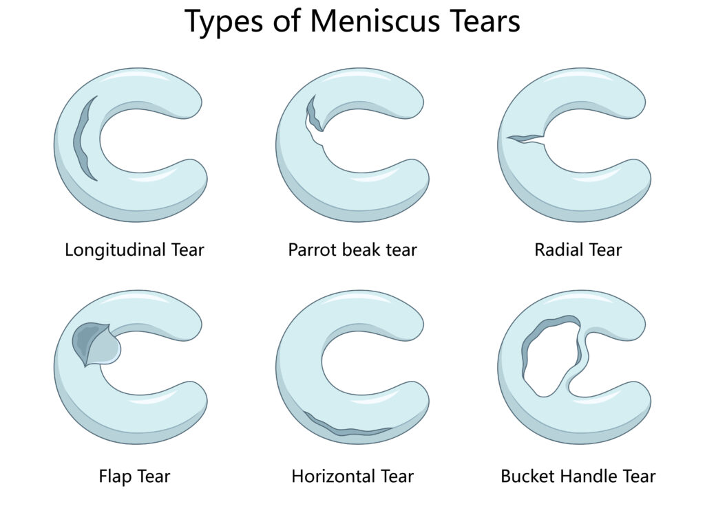 Types of meniscus tears