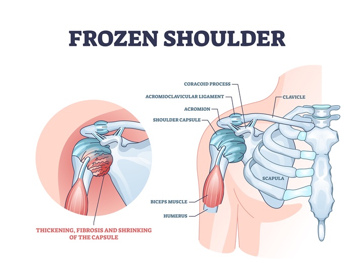 Adhesive capsulitis diagram