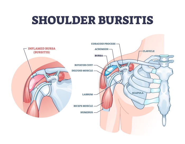 Bursitis shoulder diagram