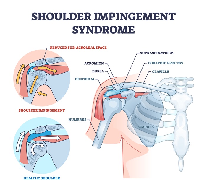 Labrum tear shoulder diagram