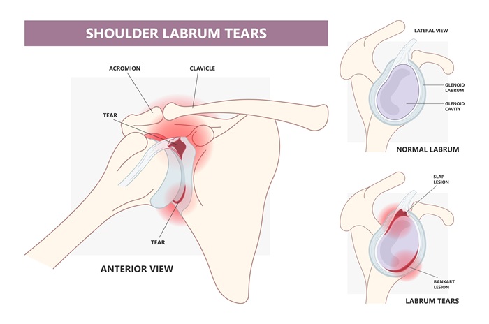 Labrum tear shoulder diagram