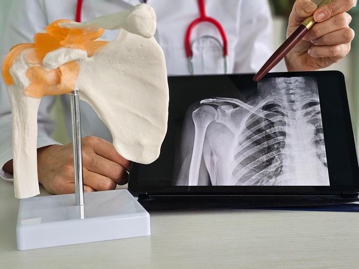 Orthopedic surgeon explaining shoulder surgery to a patient