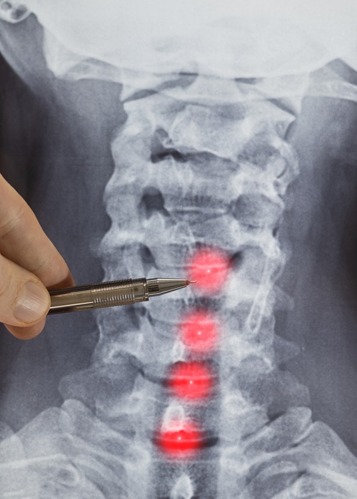 Neck x-ray showing spine injuries