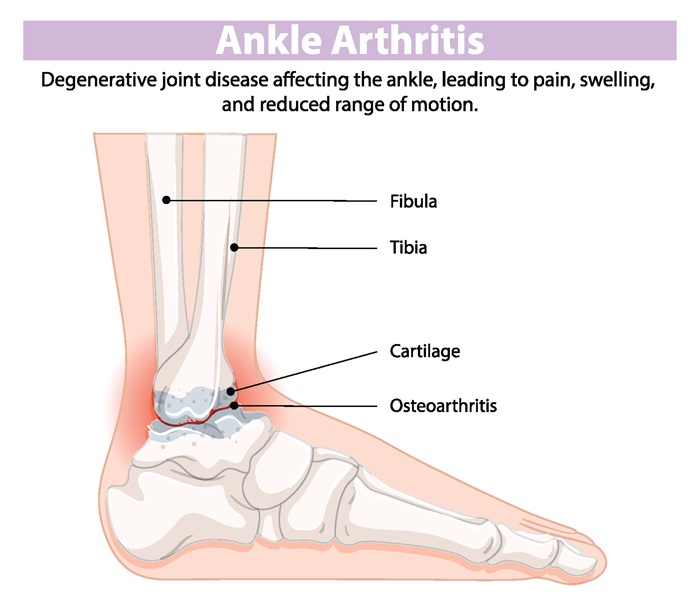 Diagram of osteoarthritis in the ankle