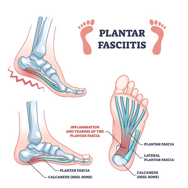 Plantar fasciitis diagram