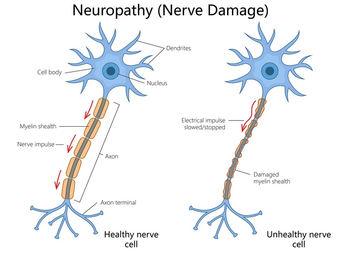 Diagram of nerve damage from neuropathy