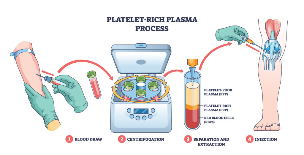 Diagram of PRP injection in the knee