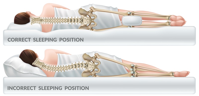Diagram of best sleeping position for lumbar radiculopathy